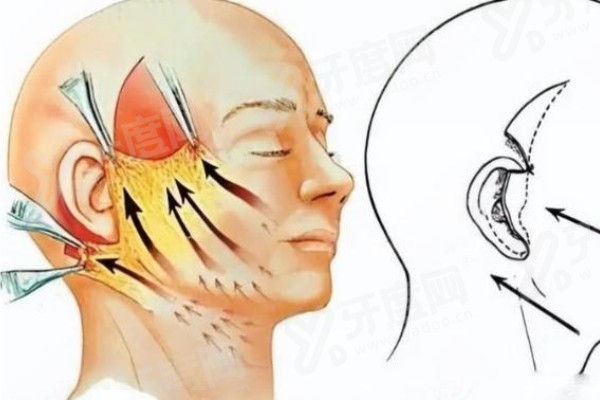 西安李高峰拉皮手术怎么样？技术靠谱经验丰富，皮肤自然复位，切口隐蔽，修复快！