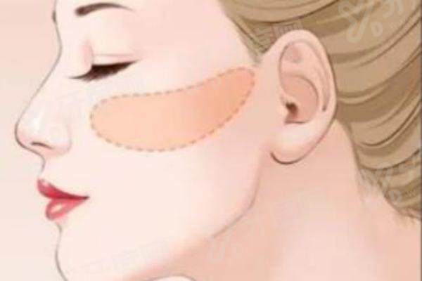 张立天做的颧骨内推会垮吗？术后1年稳定效果+圣嘉新坐诊信息给你安心答案