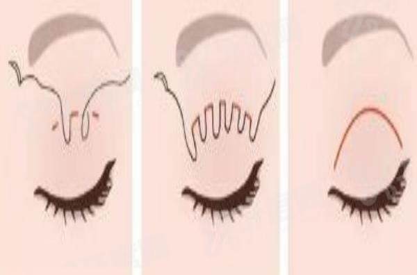 王庆良双眼皮实例多吗？答案是超多！口碑也超棒，审美沟通术后服务全在线