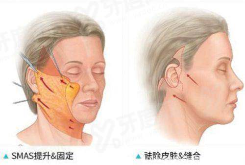 长沙美莱刘欢医生口碑和评价怎么样？手术安心好评众多，揭秘手术案例