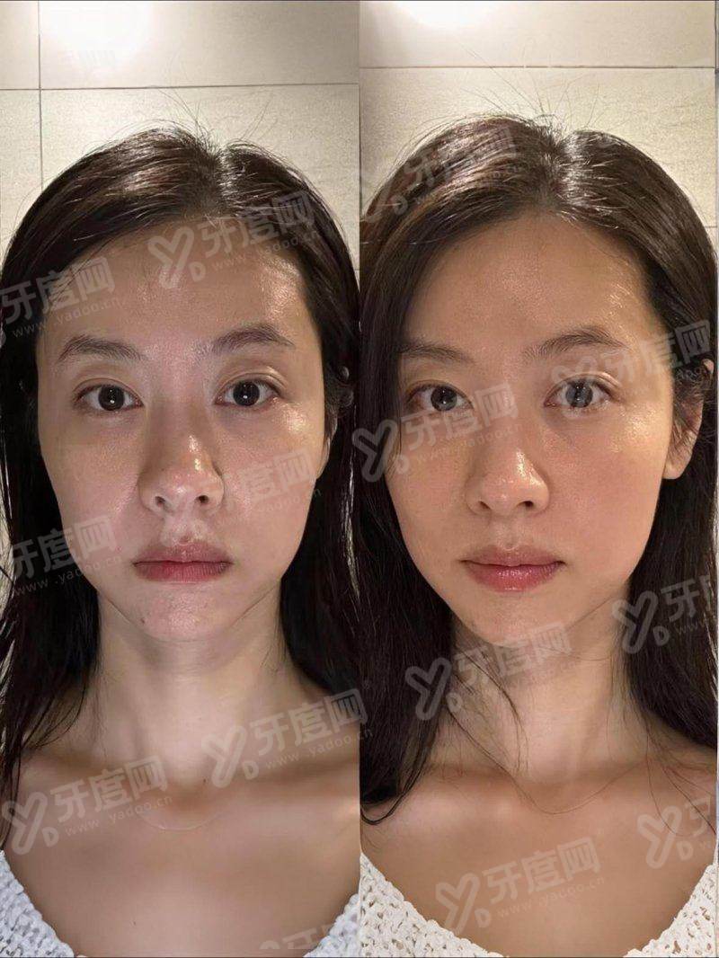 米诺地尔会产生依赖性吗？因人而已，能长头发且治疗脱发6个月见效