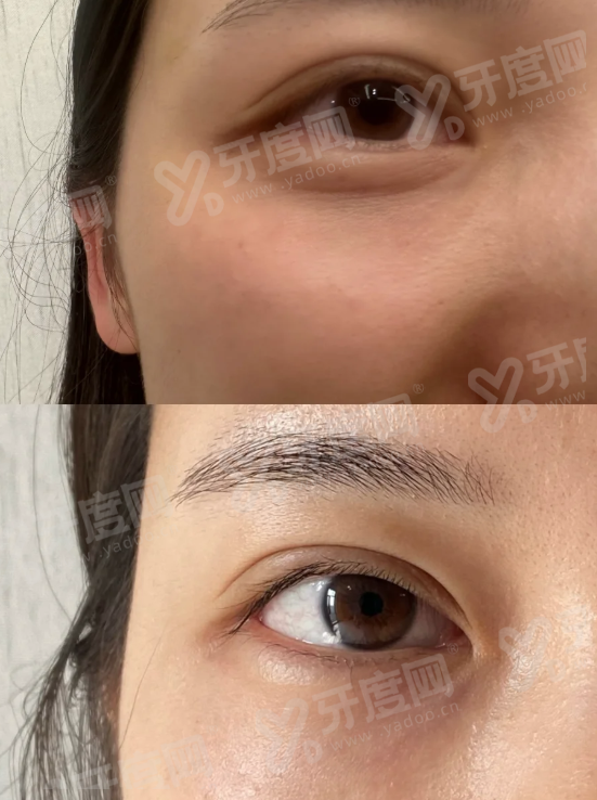 深圳郭世伟医生做鼻子多少钱？隆鼻4800+/鼻综合手术9800+/鼻修复手术2.5万+