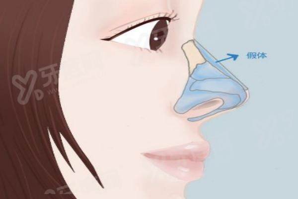 杭州黄益凡医生隆鼻怎么样？50份术后分享+全流程体验一文说清！