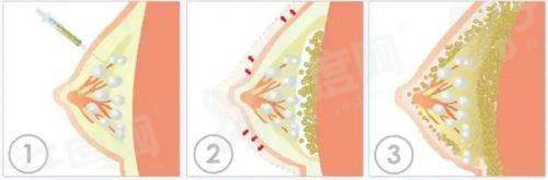 董岩岩假体隆胸咋预约？北京嘉禾医院挂号攻略及避坑指南来了！