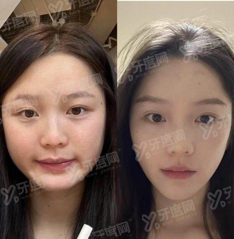 刘双立磨骨三件套多少钱？下颌角3.8w/颧骨4.5w/下巴3.2w元起