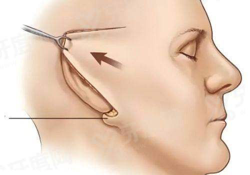 二、卢玲医生双眼皮成效怎么样yanke.yadoo.cn