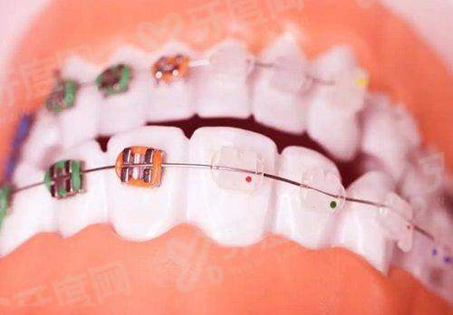 二、鄞州溢泽口腔医院价格表：种植牙1580+牙齿矫正5800起yanke.yadoo.cn