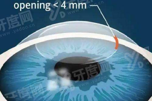 四、长沙宏朗眼科医院就诊攻略（地址及预约方式）yanke.yadoo.cn