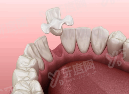 义获嘉全瓷牙是哪个国家的？列支敦士登！一文解析义获嘉全瓷牙价格表！ 