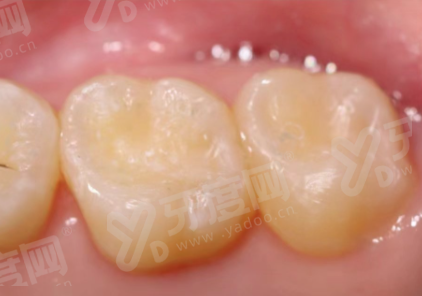 种牙一期疼还是二期疼呢？一文带你搞懂疼痛差异、间隔时长及手术费用