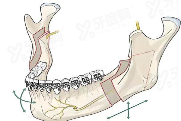 北京联合丽格何照华技术如何？北京何照华磨骨怎么样？真实反馈：磨骨技术成熟