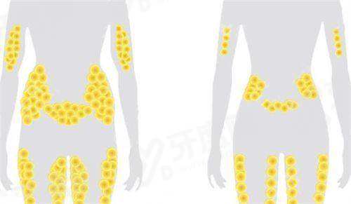 深圳刘丁吸脂怎么样？技术优效果好，刘丁吸脂常见部位6000元起