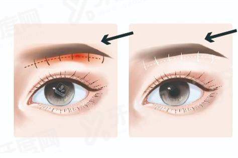 国内眼周筋膜提升哪个医生好？北京李喆/穆宝安+上海倪峰/张园园+深圳曹孟君/祁峰等医生上榜