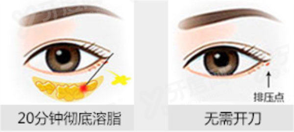 深圳鹏程王哲彗祛眼袋技术怎么样？稳准狠解决问题，价格透明合理，解析祛眼袋多少钱！