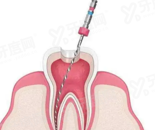 吉林龙潭范增悦口腔种植牙价格表：国产种植牙2.5k/韩国种植牙3.5k/欧洲进口种植牙5k