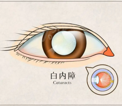 济宁白内障免费手术政策怎么申请？按户籍、贫困情况等对应流程办，政府多年高额补贴助复明