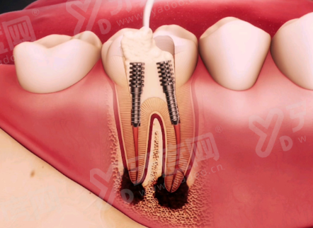 镶牙都是镶一颗包两颗？不一定，种牙/活动义齿不用！