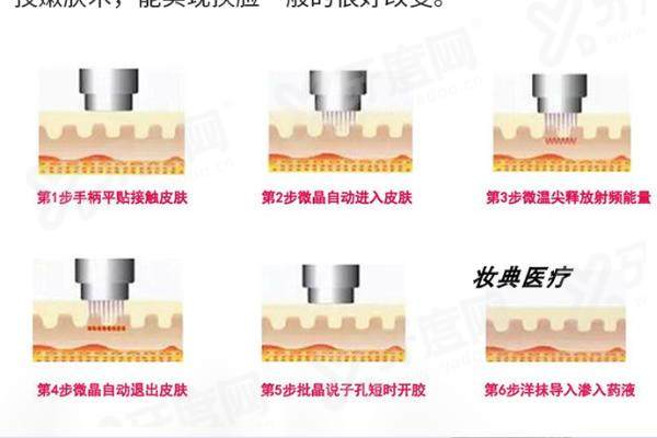 上海李敏灌注提升怎么样？超细微针精细灌注激活胶原再生，温和且修复快！