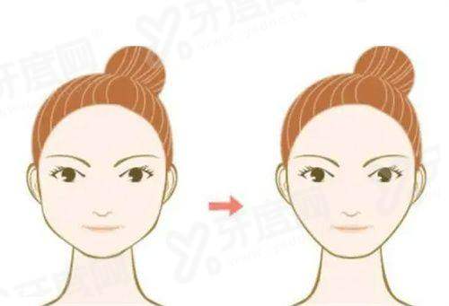 成都华生铂悦吸脂真的可以不用穿塑身衣吗？真的！看真实案例&医院专业测评