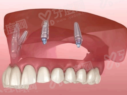 二、衡水可恩口腔医院怎么样？（正规靠谱且技术实力强）yanke.yadoo.cn