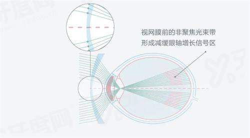 二、深圳爱尔眼科医院需要预约吗？yanke.yadoo.cn