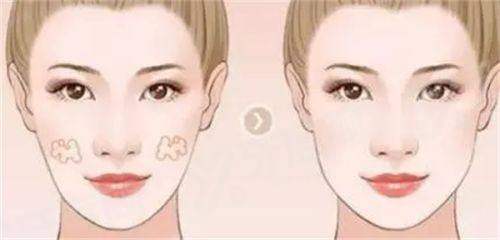 卢丙仑在哪家医院坐诊？在西安画美！卢丙仑擅长拉皮/眼鼻综合/修复手术