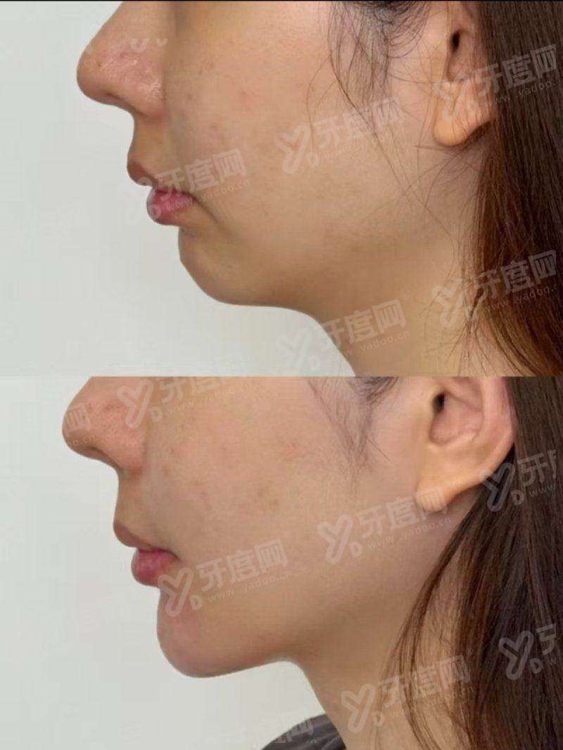 二、张安利双眼皮修复成效yanke.yadoo.cn