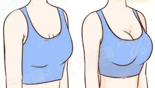 艾剑英医生做隆胸怎样？口碑佳细节控打造自然胸，附真实案例及12800元起价