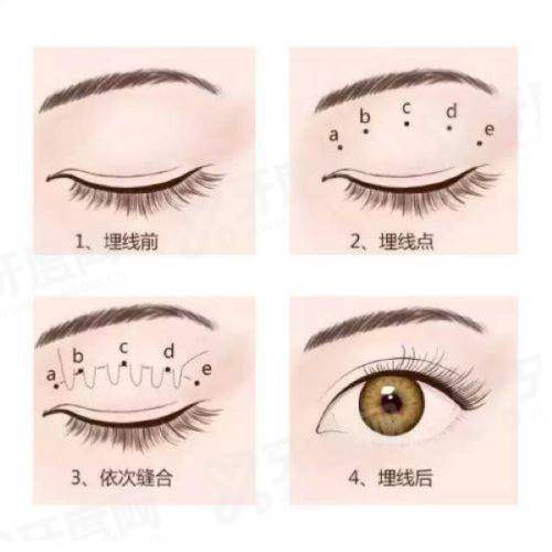 成都李瑞萱双眼皮真实案例？真实实例获求美者点赞|多眼型姐妹都满意|技术精准价目公开无隐形消费