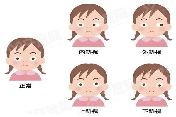 北京民众眼科医院做斜视手术怎么样？专业医生团队+先进技术，精准矫正斜视效果显著