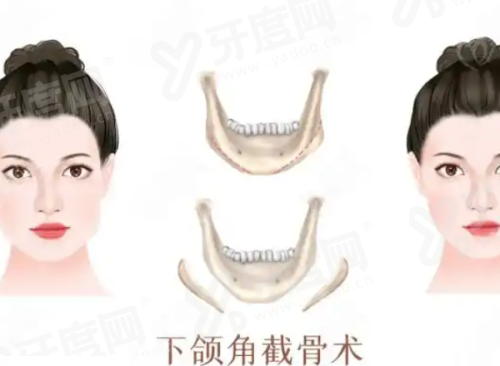 张立天和张笑天在业界的评价如何？都是资深口碑磨骨医，按脸选+基础价近复杂术有差异