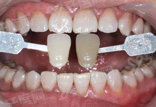 三、隐适美隐形矫正的价格？yanke.yadoo.cn