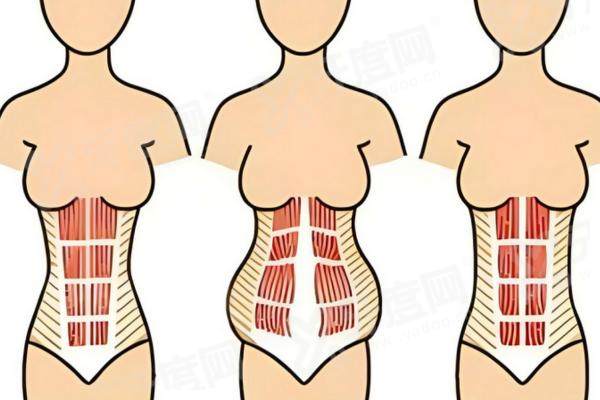 郑子良做腹壁的口碑和评价如何？技术好 疤痕隐蔽 修复成效自然