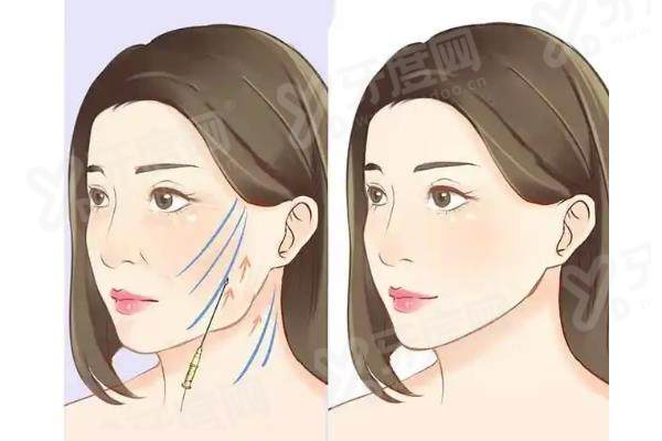 南京市康美美容医院张让虎擅长拉皮手术吗？当然！附张让虎预约挂号全攻略