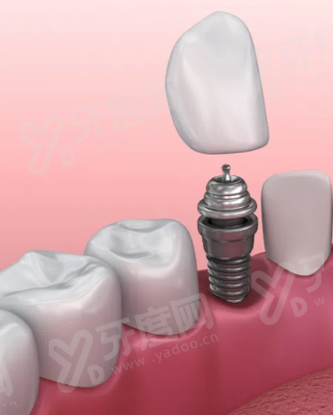 沈河欢乐仁爱口腔医院怎么样？种植/矫正价格表+地址曝光！