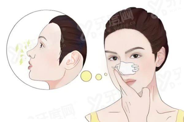 保定杜建龙医生做鼻子怎么样？技术细节比假体更稳，做鼻子价格一览