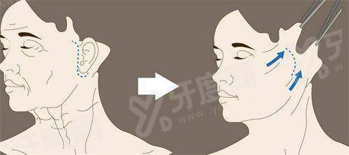 李方伟做富贵包手术安全吗？安全！采用微创技术+精准定位抽脂，顾客3个月内无复发