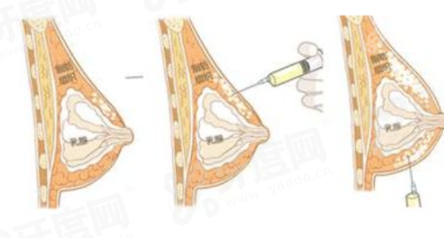 二、杜建龙做的双眼皮多少钱？yanke.yadoo.cn