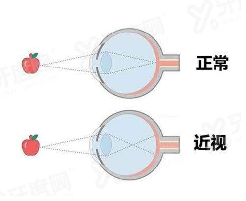 二、苏州光明眼科医院怎么样？（正规资质，技术实力较强，服务口碑较好）yanke.yadoo.cn