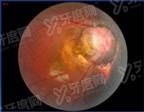 二、鲁南眼科医院怎么样？（正规靠谱，技术设备精良，医生经验多）yanke.yadoo.cn