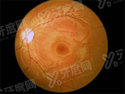 湖州爱尔眼科医院如何预约挂号？3种挂号方式，全飞秒1.8万起价格表公开