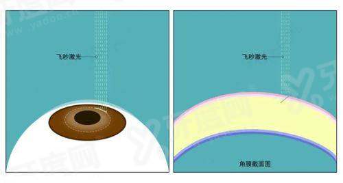 泗洪朝聚眼科医院近视手术多少钱？全飞秒 9800 元起，摘镜恢复快，清晰视界轻松拥有！