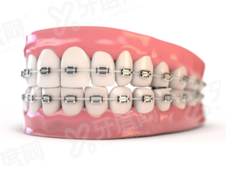 延安致美口腔医院价目表：种植牙5.8k/牙齿矫正6.8k元起