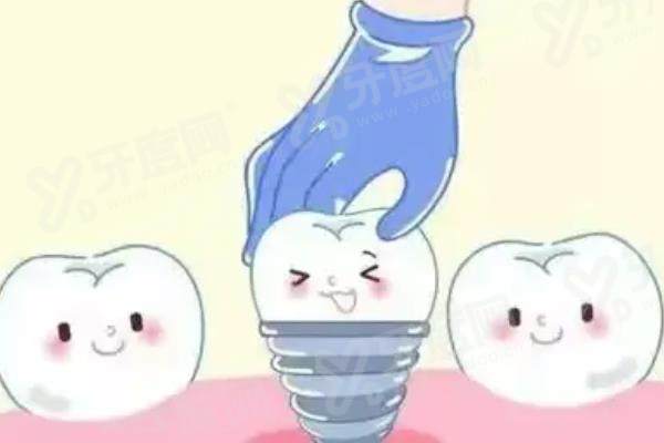 德国种植牙好还是韩国种植牙好？解析德国种植牙与韩国种植牙质量/寿命/价格差别