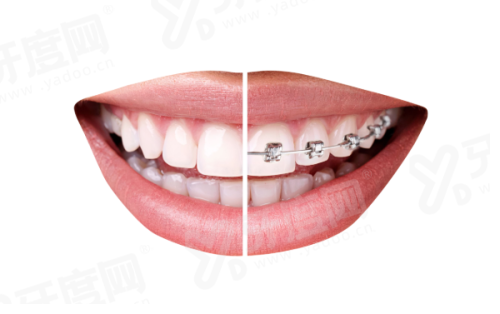 二、佛山爱顿口腔正畸价格？yanke.yadoo.cn