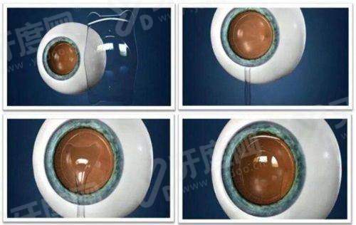 二、人工玻璃体球囊植入术多久修复yanke.yadoo.cn