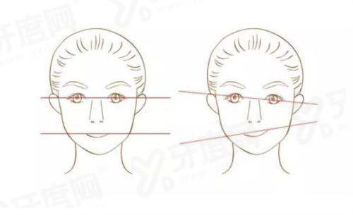 李冠英医生双眼皮咋样？免动刀效果好，中高端档次