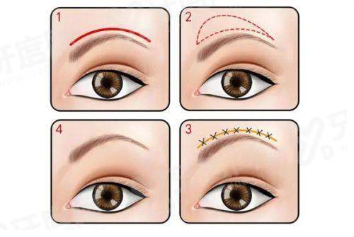 三、郑州孟宝玺双眼皮的价格参考yanke.yadoo.cn