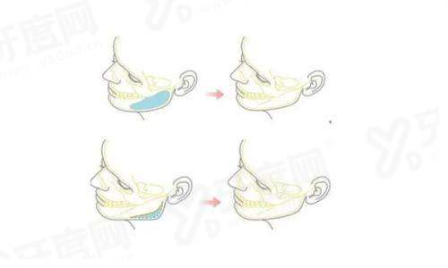 章庆国和郭树忠谁做的耳朵好？都很好，在耳廓形态设计和软骨雕刻上堪称标杆