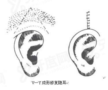 张正文医生耳再造手术案例分享：儿童、扩张器及二次修复，张正文耳再造技术好